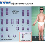 Hội chứng Turner là gì? Phương pháp điều trị hội chứng Turner